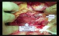 Perforacja aorty podczas laparoskopii 