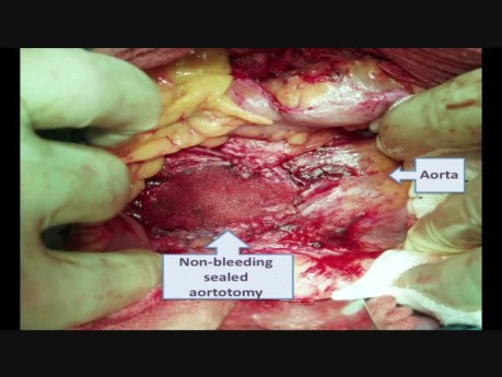 Perforacja aorty podczas laparoskopii 