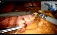 Resekcja rękawowa żołądka z użyciem robota