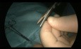 Laparoskopowe leczenie przepukliny pachwinowej, technika przezskórna