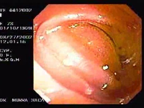Gruczolakorak żołądka z komórkami sygnetowatymi - endoskopia (3 z 4)