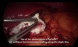 Technika chirurgiczna z wykorzystaniem TachoSil® w celu zapewnienia wystarczającej hemostazy i uszczelnienia podczas laparoskopowej rękawowej resekcji żołądka