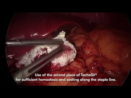 Technika chirurgiczna z wykorzystaniem TachoSil® w celu zapewnienia wystarczającej hemostazy i uszczelnienia podczas laparoskopowej rękawowej resekcji żołądka