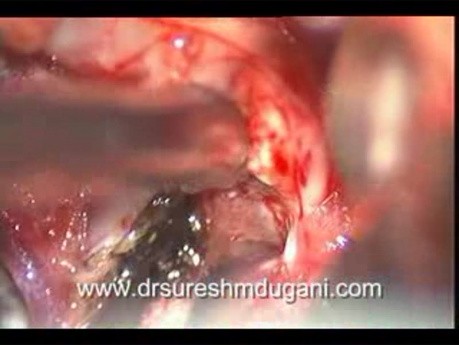 Mikrochirurgiczne usunięcie torbieli koloidowej III komory mózgu z dostępu przezkomorowego