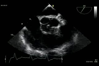 Dwupłatkowa zastawka aorty