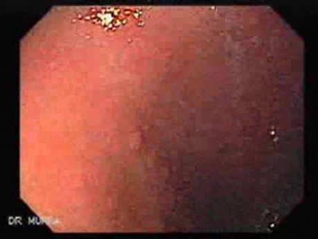 Rak żołądka - metaplazja jelitowa - endoskopia (2 z 7)