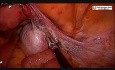 Obustronna adneksektomia z powodu masy w jajniku
