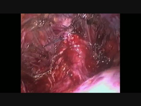 Cewka moczowa - laparoskopowa radykalna prostatektomia 