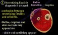Necrotizing Fasciitis czyli nekrotyczne zapalenie powięzi - skomplikowane przypadki - część II