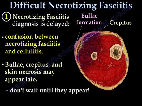 Necrotizing Fasciitis czyli nekrotyczne zapalenie powięzi - skomplikowane przypadki - część II