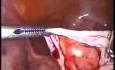 Leczenie laparoskopowe torbieli jajnika