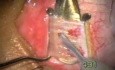 Bezkrwawa operacja zeza z użyciem noża Fugo