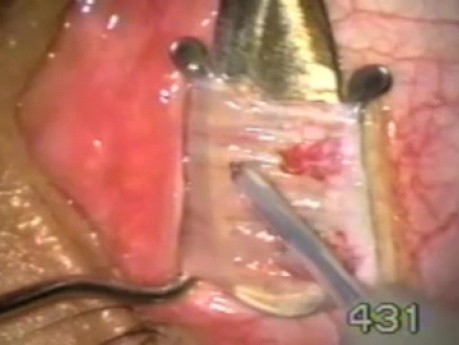 Bezkrwawa operacja zeza z użyciem noża Fugo