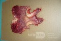 Obraz endoskopowy raka włóknistego żołądka obejmującego dno, trzon i część przedodźwiernikową (42 z 47)