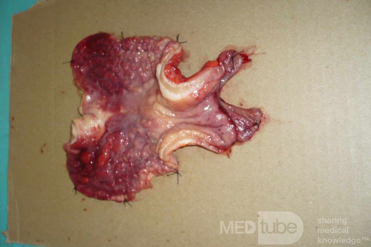 Obraz endoskopowy raka włóknistego żołądka obejmującego dno, trzon i część przedodźwiernikową (42 z 47)