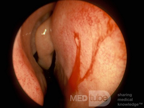Duże naczynia krwionośne w obrębie przedniej części przegrody nosowej