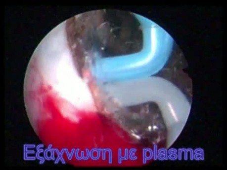 TURis Plasma Resection-Vaporization