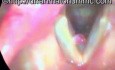 Fałd głosowy prawdziwy - polip widziany wideostroboskopowo