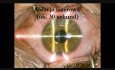 Laserowa korekcja wzroku techniką TransPRK