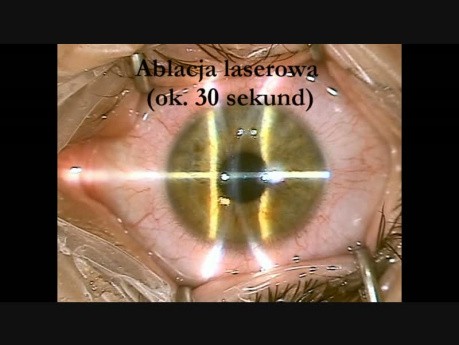 Laserowa korekcja wzroku techniką TransPRK