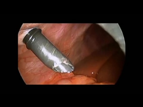 Cholecystektomia laparoskopowa u dziecka z nietypowym przebiegiem tętnicy pęcherzykowej