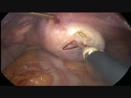Skręt jajnika prawego z torbielą - laparoskopia