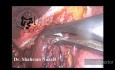 Cholecystektomia laparoskopowa obkurczonego pęcherzyka żółciowego