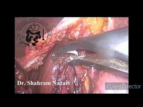 Cholecystektomia laparoskopowa obkurczonego pęcherzyka żółciowego