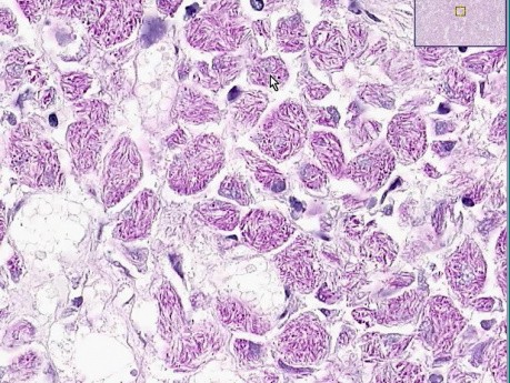 Mykobakterioza (Mycobacterium avium intracellulare complex)