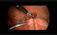 Laparoskopowa appendektomia