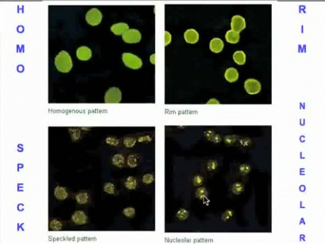 Choroby układu immunologicznego - patomorfologia - część 6f