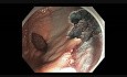 Odbytnica - polip dywanowyo powierzchni granulowanej - endoskopowa mukozektomia cz. IV