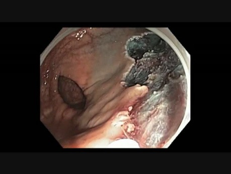 Odbytnica - polip dywanowyo powierzchni granulowanej - endoskopowa mukozektomia cz. IV