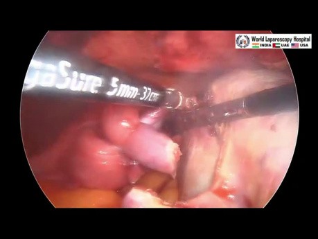 Chirurgia laparoskopowa w przypadku skrętu torbieli jajnika