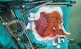 Laparoscopic Radical Subtotal Gastrectomy 