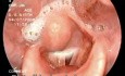 Jeziorko śliny w części krtaniowej gardła z powodu dysfagii w przebiegu zapalenia kości i szpiku postawy czaszki