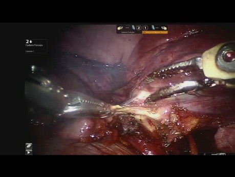 Zmiana w tętnicy płucnej wykryta podczas usuwania dolnego płata lewego płuca - powikłanie naczyniowe