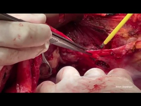 Techniczne aspekty zabiegów w górnej części brzucha w zaawansowanej chirurgii raka jajnika