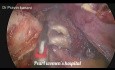 Laparoskopowa operacja przetoki jelitowo-pęcherzowej