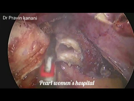 Laparoskopowa operacja przetoki jelitowo-pęcherzowej