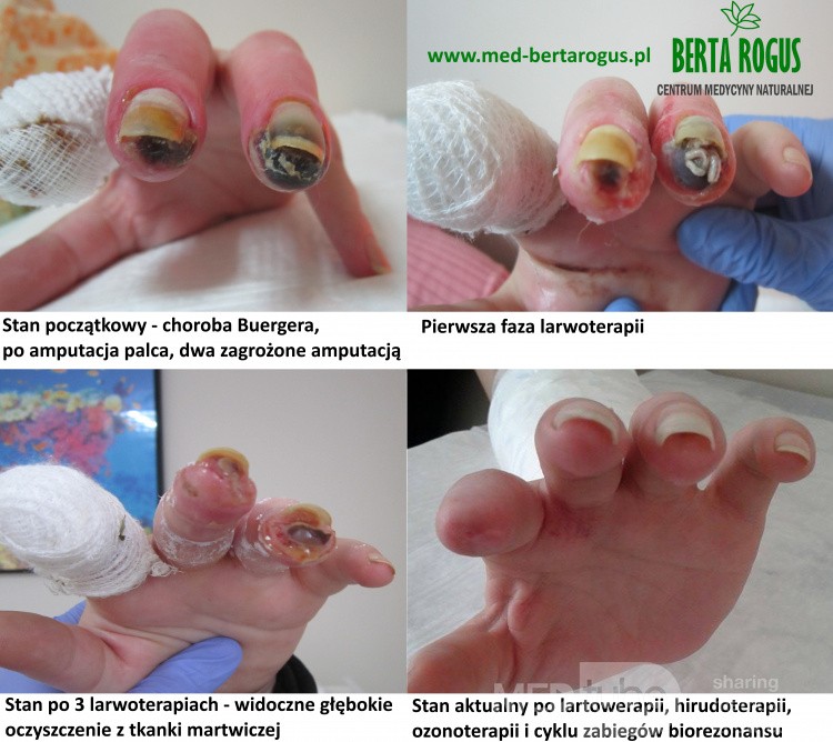 Terapia larwami – przed i po