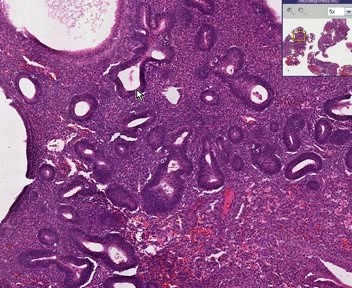 Endometrium - hiperplazja