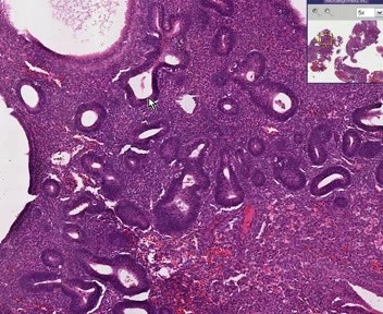 Endometrium - hiperplazja