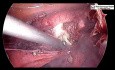 Całkowita laparoskopowa histerektomia bez użycia manipulatora macicznego