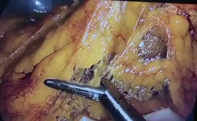 Laparoskopowa pankreatoduodenektomia (operacja Whipple'a)
