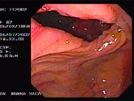 Choroba Leśniowskiego - Crohna - endoskopia (22 z 28)