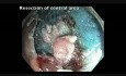 Endoskopowa resekcja śluzówkowa dużej płaskiej zmiany w kątnicy