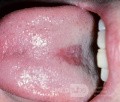 Romboidalne środkowe zapalenie języka