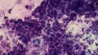 Szyjka macicy - Zapalenie szyjki macicy - Fagocytoza