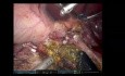 SSAT 2023 — Pankreatoduodenektomia z użyciem robota z powodu przewlekłego zapalenia trzustki 